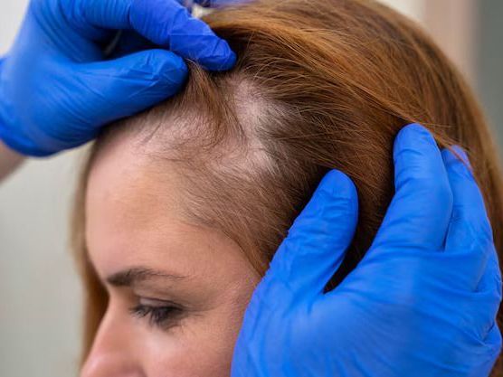 hair-loss-treatment-at-dermapuritys-womens-day-special-offers