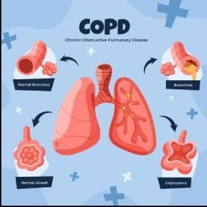 pulmonary-fibrosis-specialist-jaipur-rajasthan-asthma-bhawan-big-0