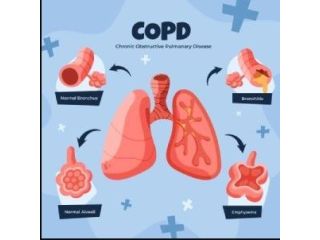 pulmonary-fibrosis-specialist-jaipur-rajasthan-asthma-bhawan-small-0