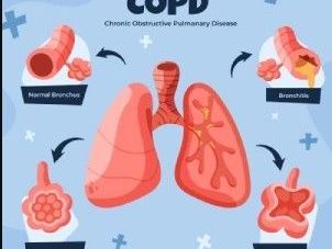 pulmonary-fibrosis-specialist-jaipur-rajasthan-asthma-bhawan