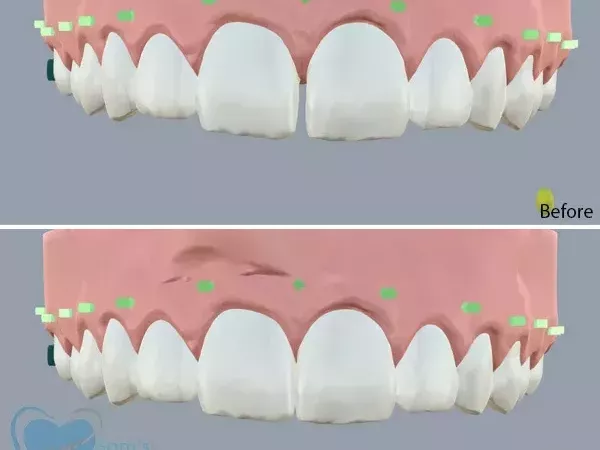 clear-aligners-for-gap-teeth-correction-in-tamil-nadu