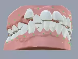gap-teeth-braces-aligners-treatments-in-tamilnadu