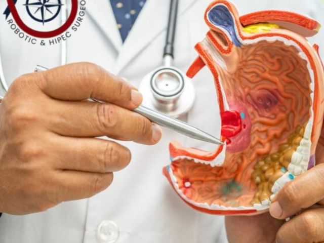 stomach-cancer-surgeon-in-ahmedabad-for-advanced-treatment