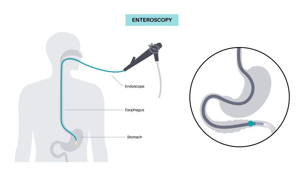 preparing-for-endoscopy-simple-tips-to-make-it-stress-free-big-0
