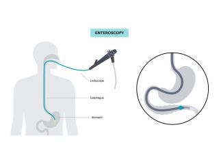 preparing-for-endoscopy-simple-tips-to-make-it-stress-free-small-0