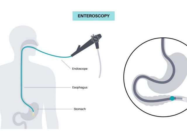 preparing-for-endoscopy-simple-tips-to-make-it-stress-free