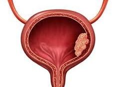 bladder-cancer-doctor-in-kolkata-dr-tarun-jindal