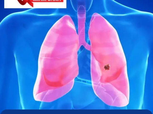 best-lung-cancer-treatment-in-ahmedabad-dr-mihir-shah