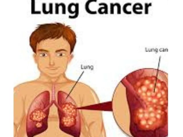 personalized-lung-cancer-treatment-in-ahmedabad