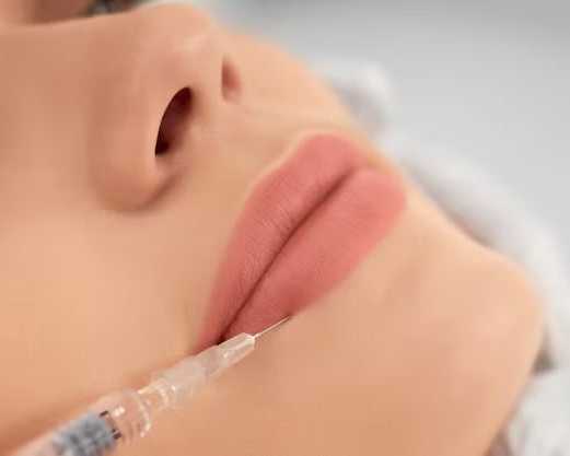 how-long-does-lip-filler-last
