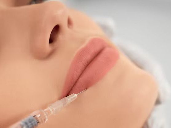 how-long-does-lip-filler-last