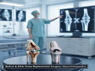 before-and-after-knee-replacement-surgery-guide