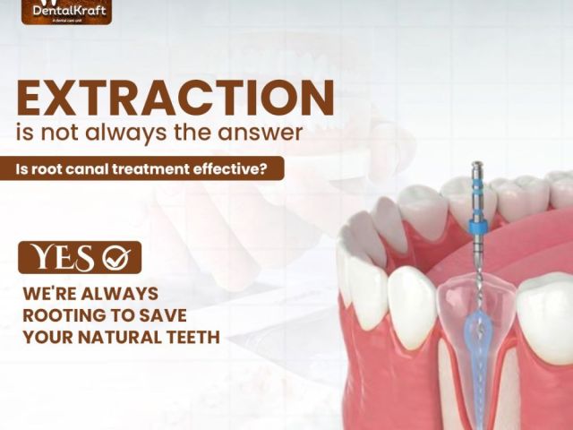 rct-clinic-in-indirapuram-for-pain-free-root-canal-treatment