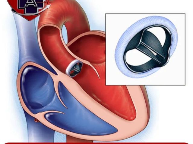 best-heart-valve-surgery-in-ahmedabad-dr-abhishek-parmar