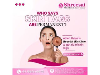 think-skin-tags-are-permanent-think-again-small-0