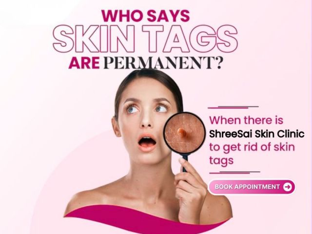 think-skin-tags-are-permanent-think-again