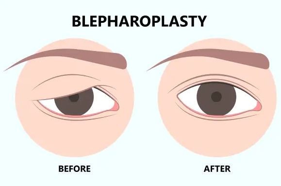 affordable-blepharoplasty-surgery-in-mumbai-harleys-cosmetic-big-0