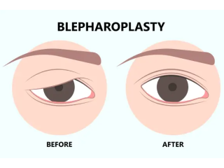 affordable-blepharoplasty-surgery-in-mumbai-harleys-cosmetic-small-0