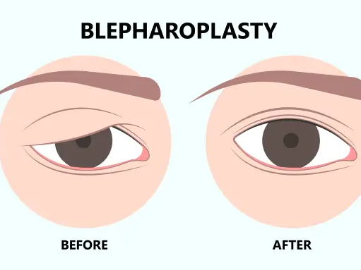 affordable-blepharoplasty-surgery-in-mumbai-harleys-cosmetic