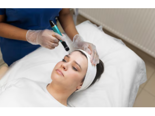 micro-needling-treatment-at-dermapuritys-small-0