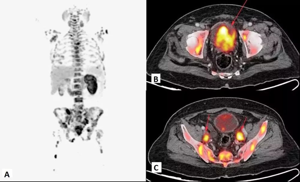 precision-cancer-detection-with-advanced-fapi-pet-ct-big-0