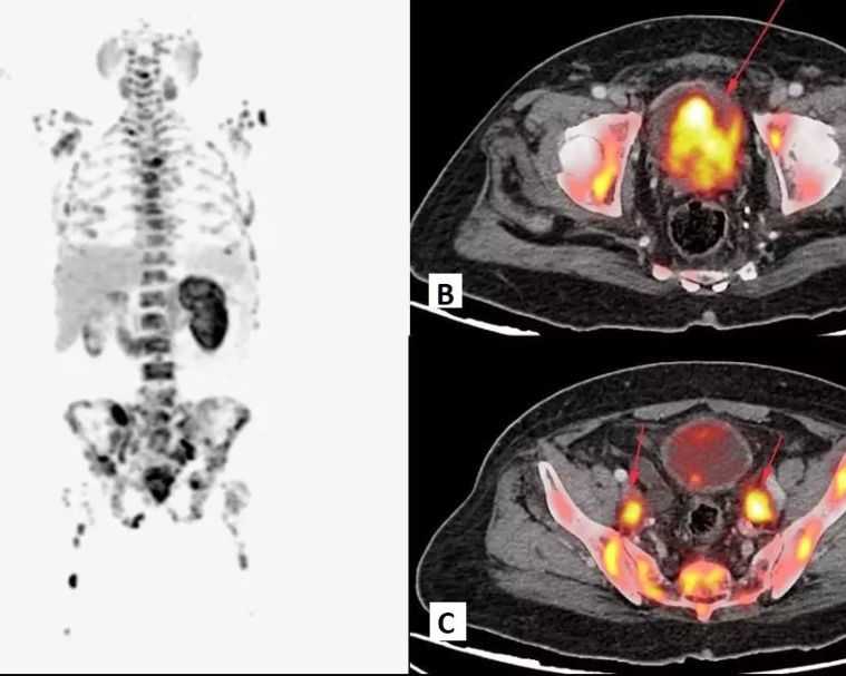 precision-cancer-detection-with-advanced-fapi-pet-ct