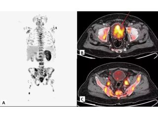 precision-cancer-detection-with-advanced-fapi-pet-ct-small-0
