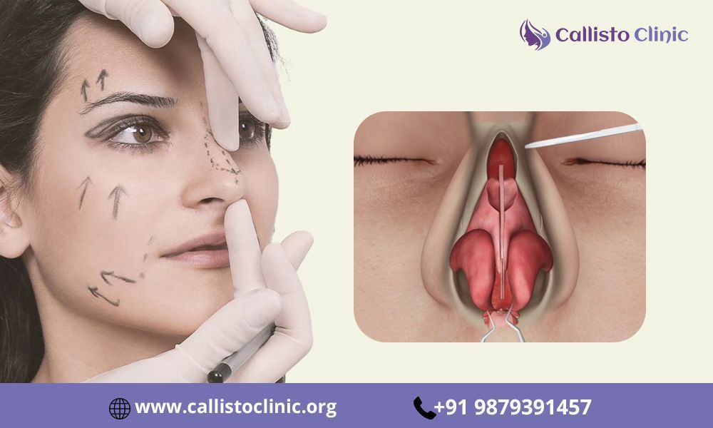 cosmetic-rhinoplasty-in-surat-big-0