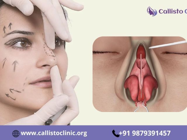 cosmetic-rhinoplasty-in-surat