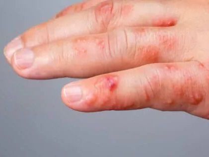 effective-skin-fungal-infection-treatment-for-healthy-skin