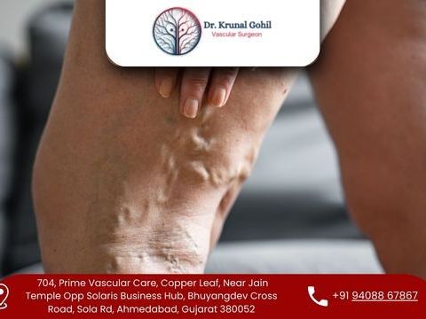 best-varicose-veins-treatment-in-india-by-dr-krunal-gohil