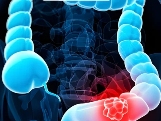 expert-colon-cancer-surgery-in-ahmedabad-dr-dhaval-patel