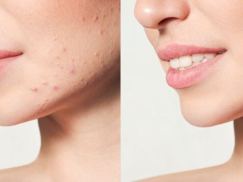 acne-scars-treatment-in-gurgaon-for-clear-even-skin-gurgaon