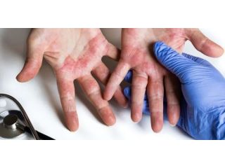 effective-atopic-dermatitis-treatments-in-gurgaon-small-0