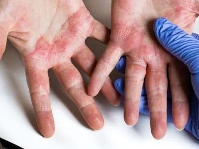 effective-atopic-dermatitis-treatments-in-gurgaon
