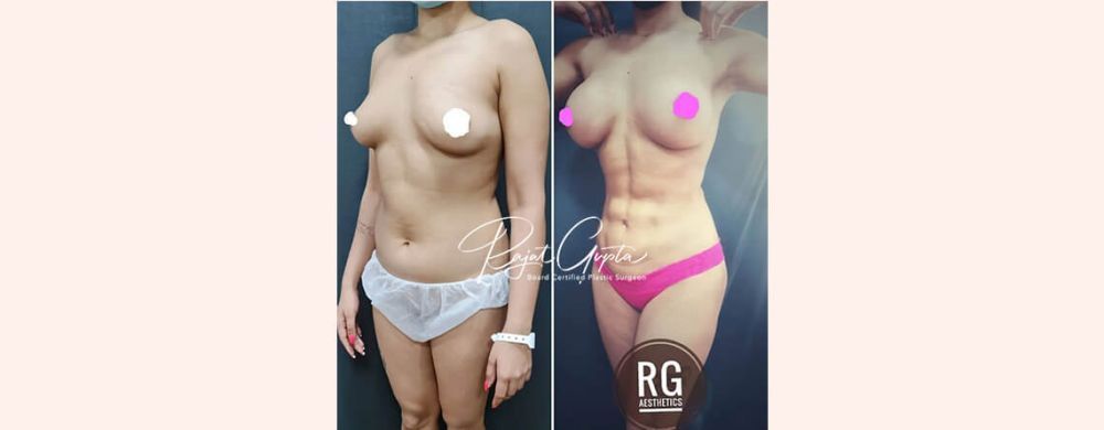top-rated-liposuction-surgeons-with-patient-reviews-big-0