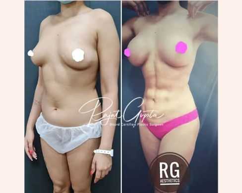top-rated-liposuction-surgeons-with-patient-reviews