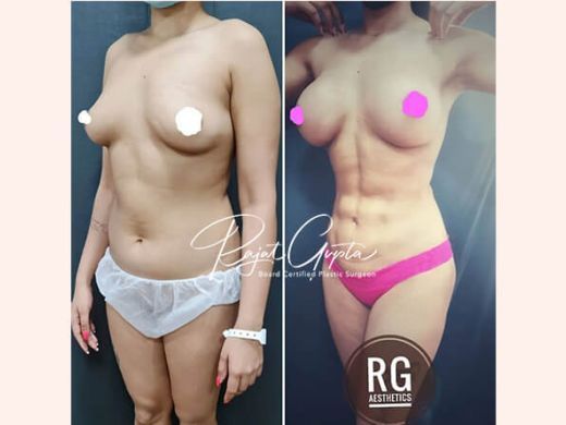 top-rated-liposuction-surgeons-with-patient-reviews