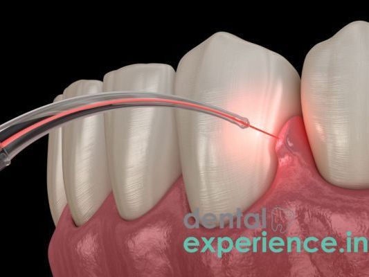 gingivectomy-gum-reshaping-treatment-best-dental-clinic-kochi