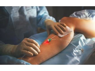 modern-technology-for-treating-varicose-veins-small-0