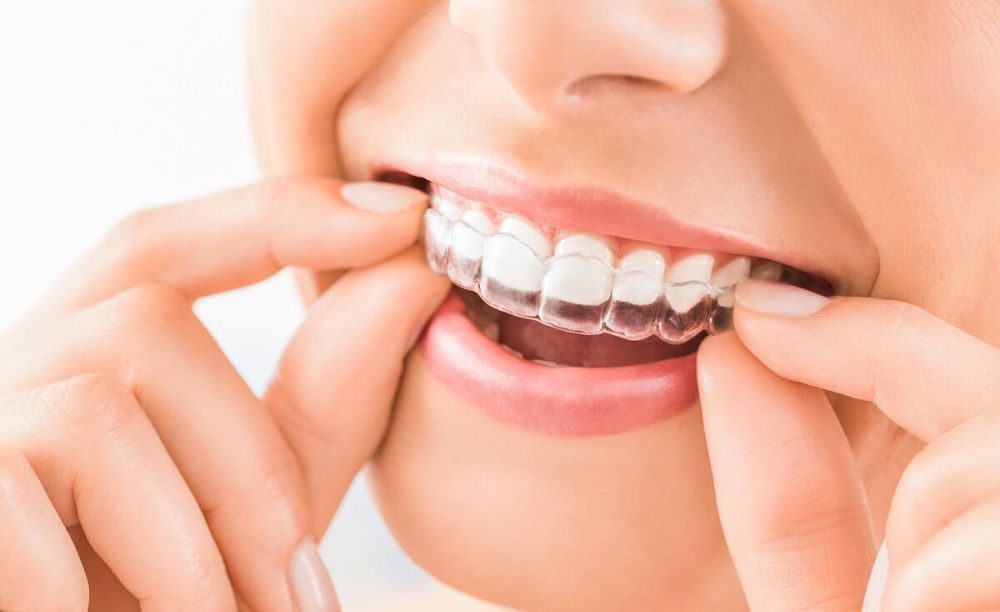 top-clear-aligners-in-pune-advanced-teeth-straightening-big-0