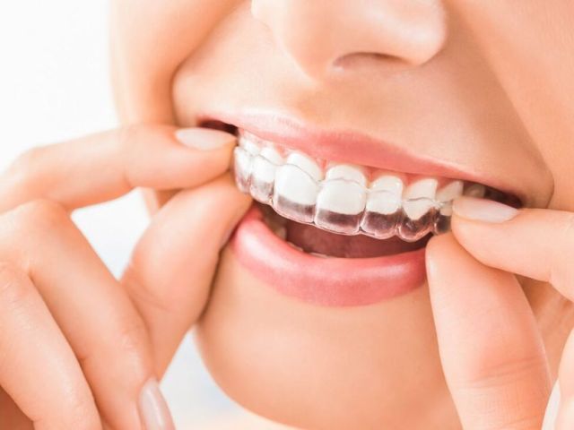 top-clear-aligners-in-pune-advanced-teeth-straightening