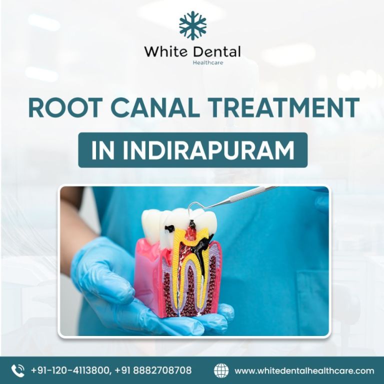 best-root-canal-treatment-in-indirapuram-big-0