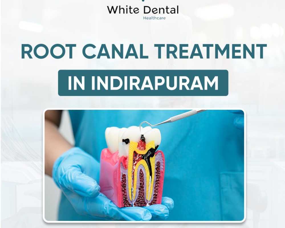 best-root-canal-treatment-in-indirapuram