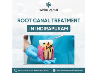best-root-canal-treatment-in-indirapuram-small-0