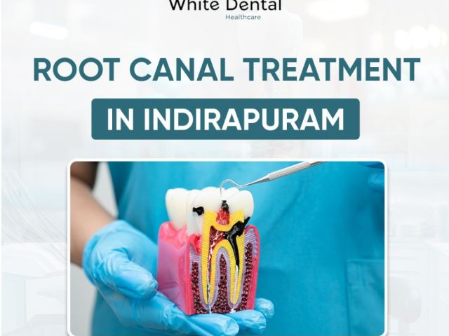 best-root-canal-treatment-in-indirapuram
