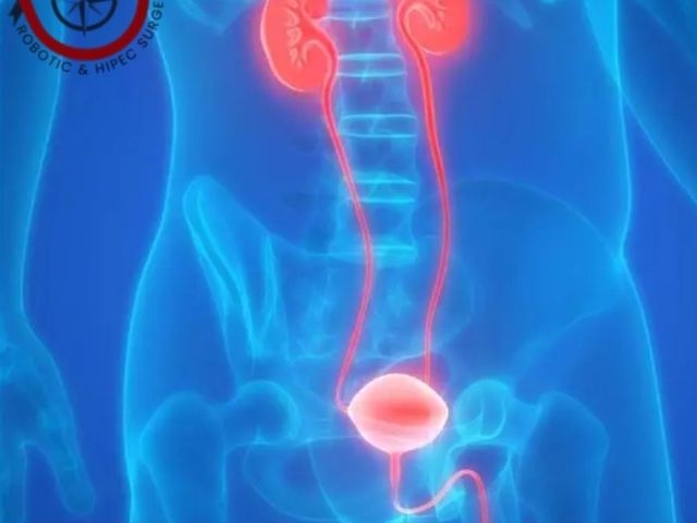 best-urinary-bladder-cancer-treatment-in-ahmedabad