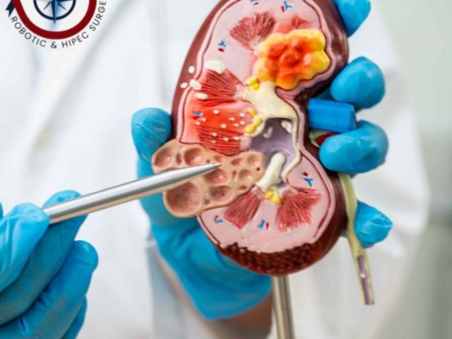 kidney-cancer-surgeon-in-ahmedabad-dr-nitin-singhal