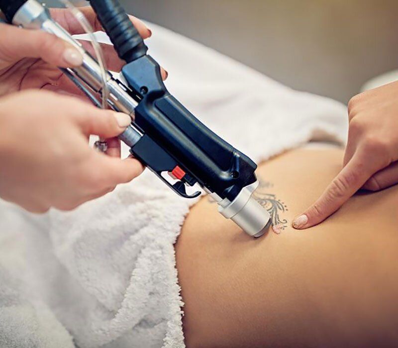 laser-tattoo-removal-safe-effective-advanced-solution-big-2