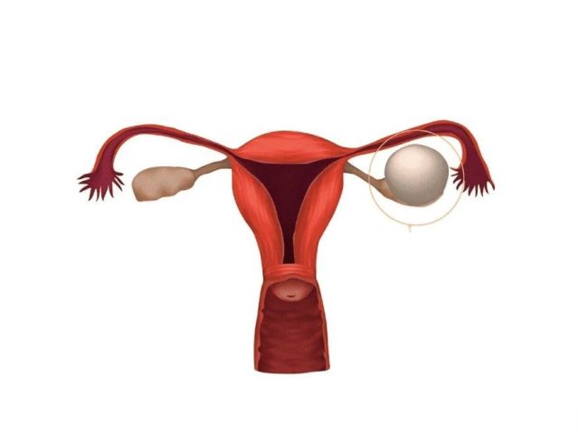 trusted-ovarian-cyst-treatment-doctor-in-faridabad-today